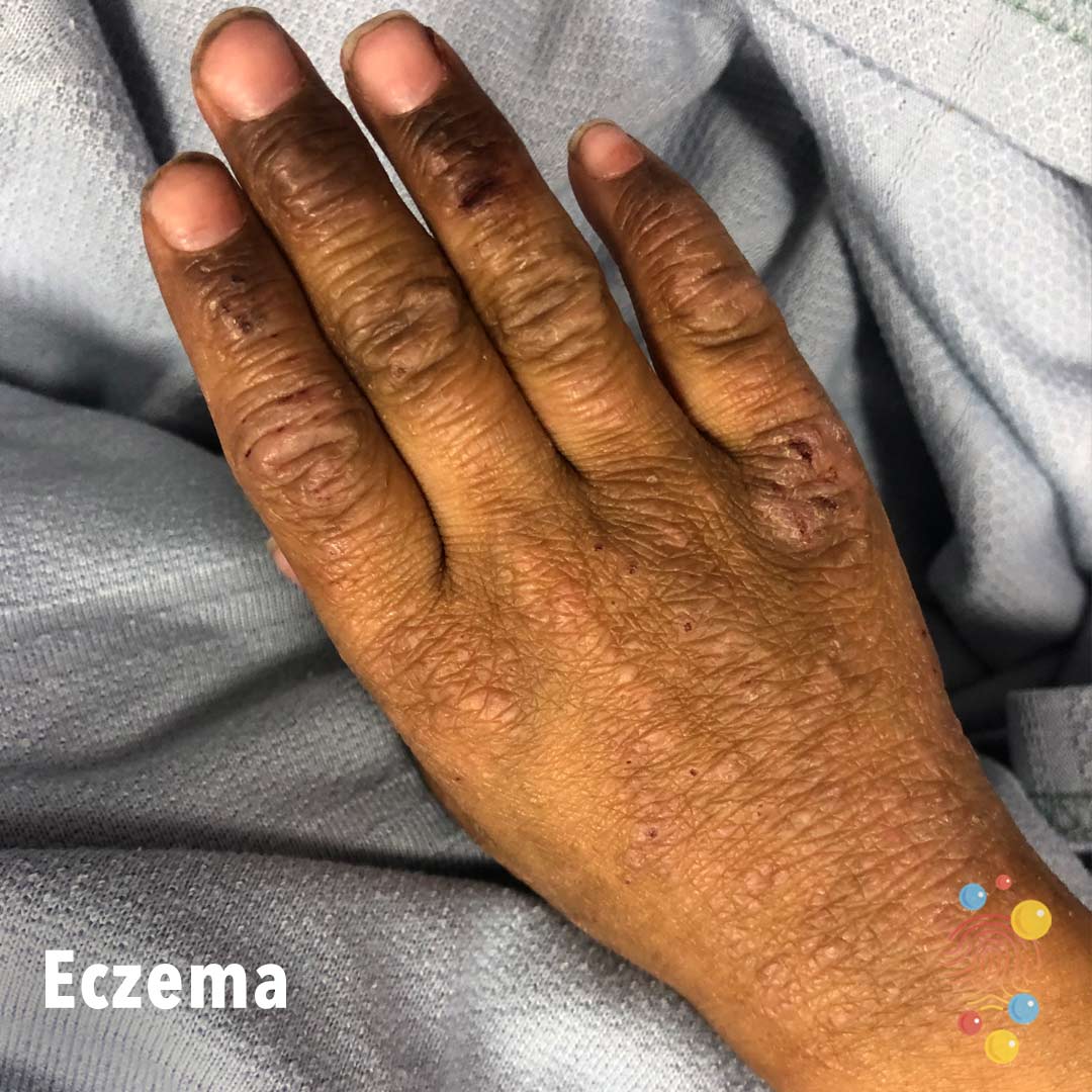Eczema Cleansing